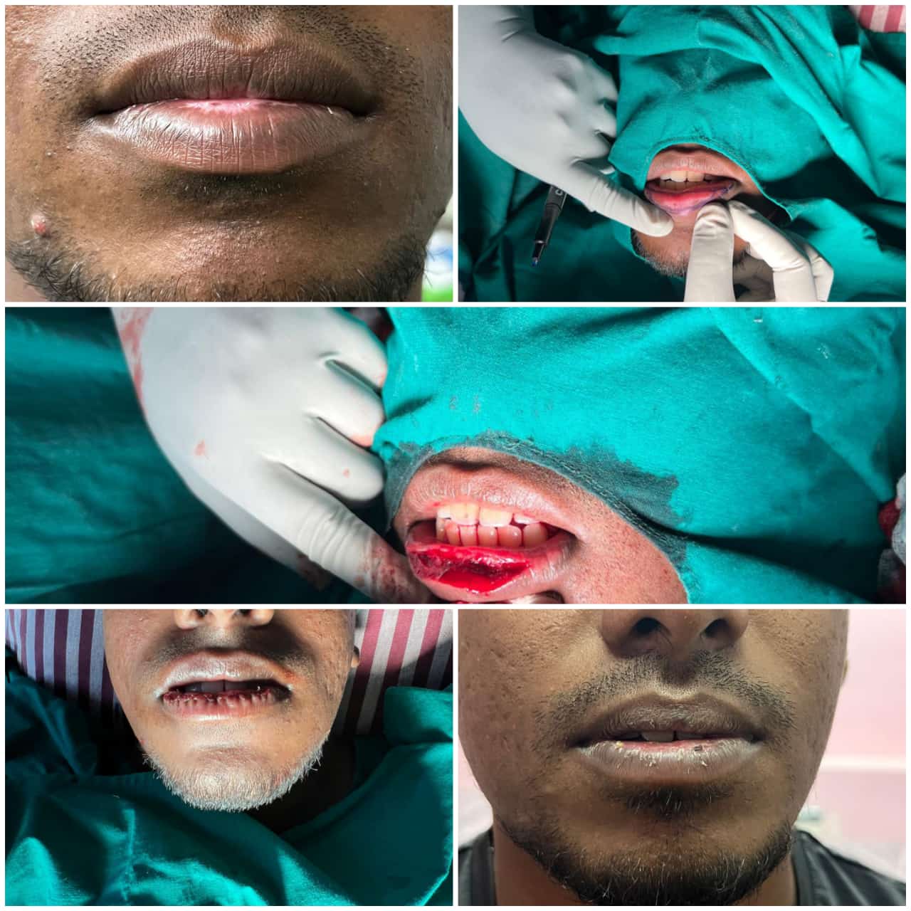 Lip reduction surgery