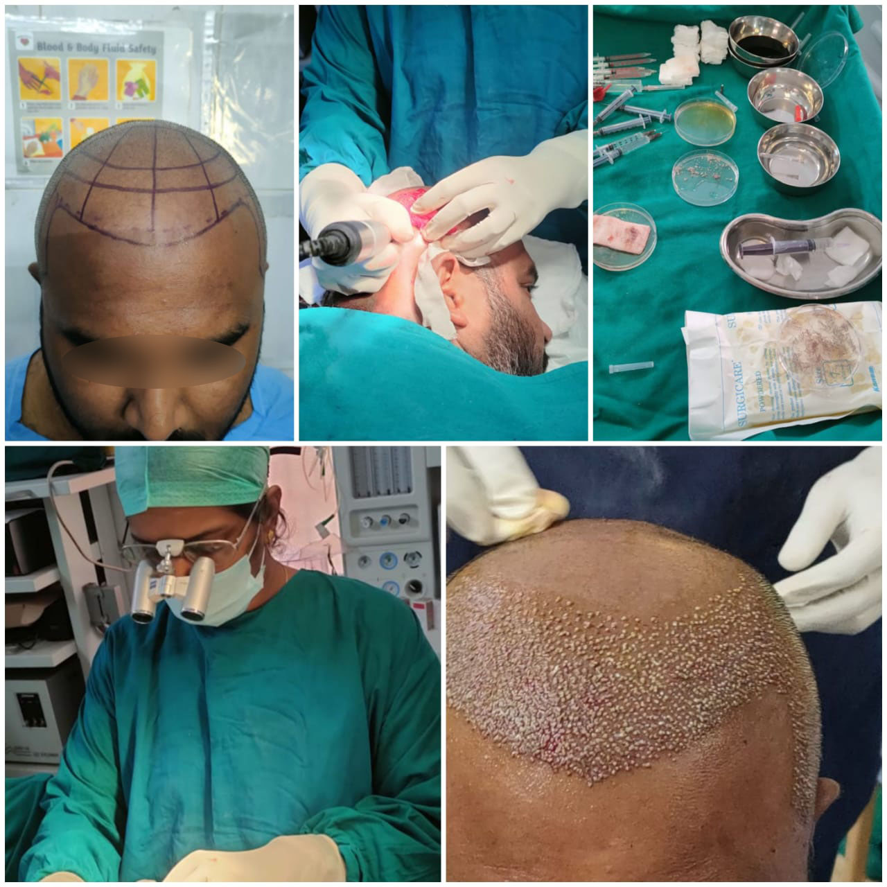 Hair plantation