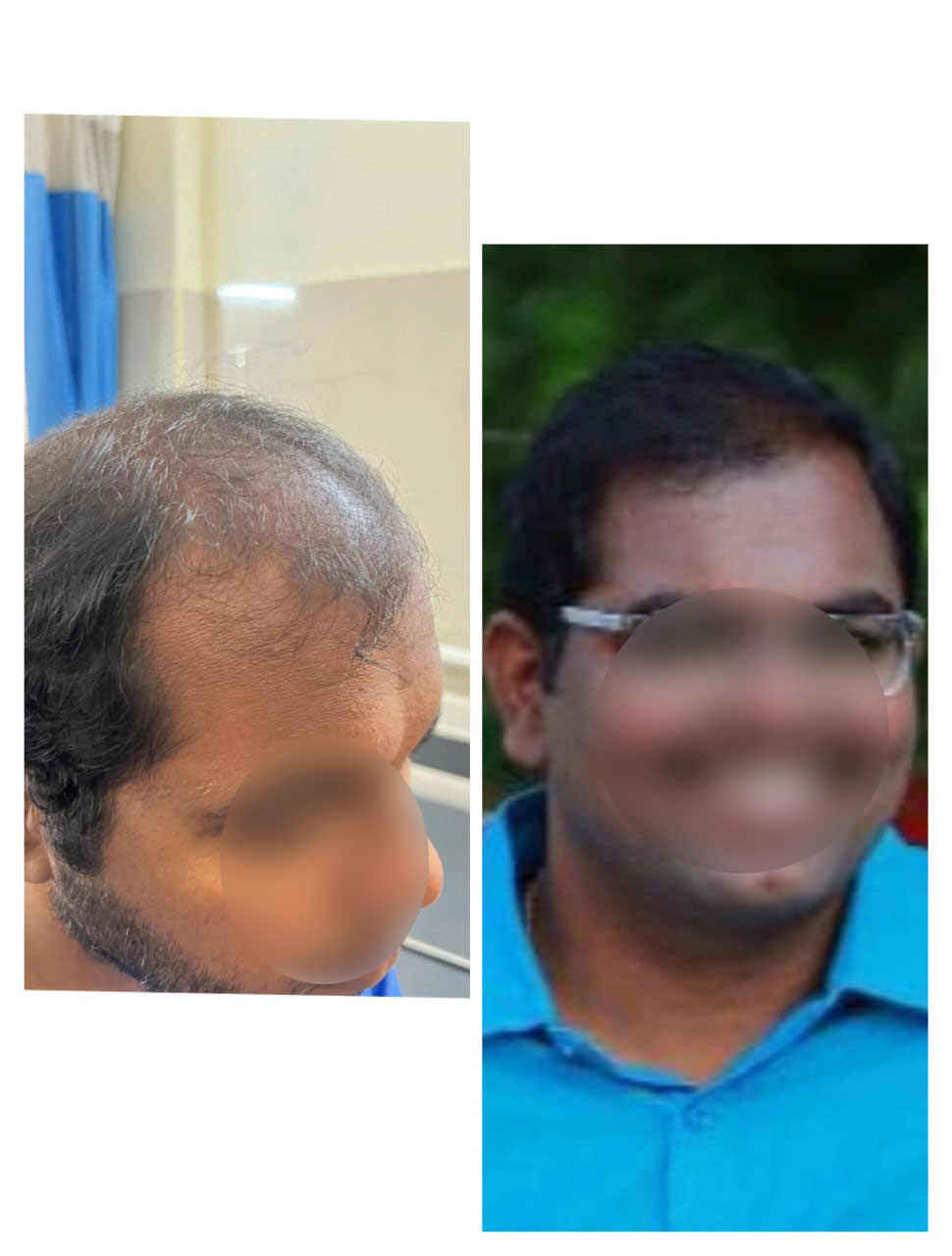 Hair plantation