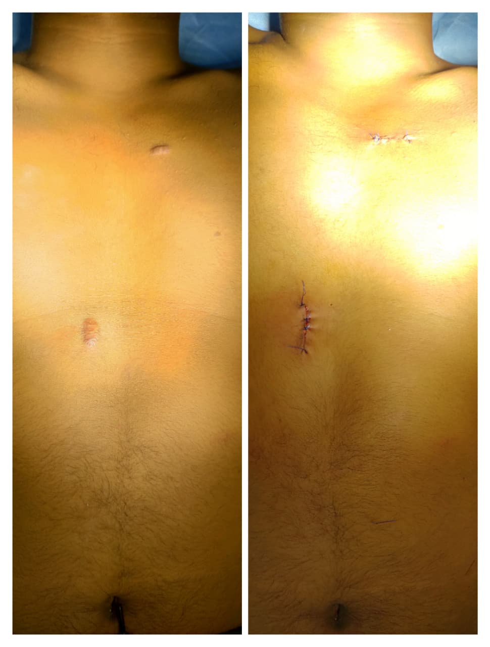 Keloid